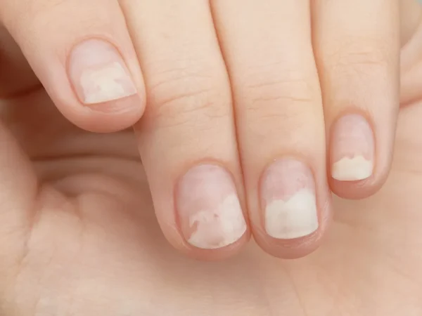 Imagem de Unha Com Onicólise