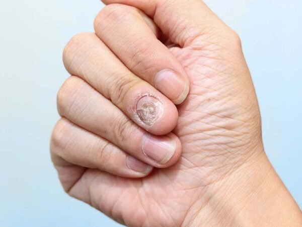 Imagem de Unha com Micose